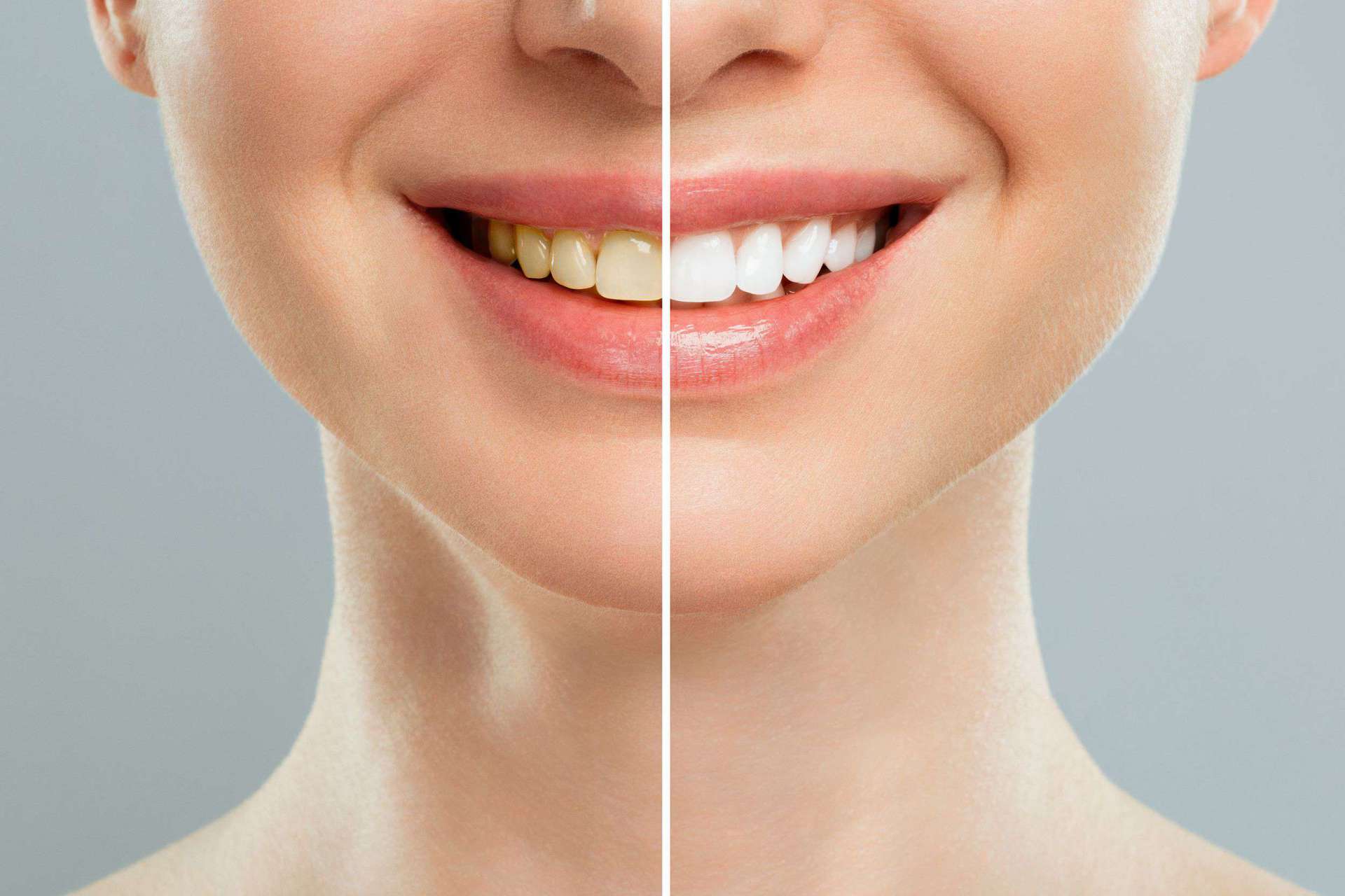 Teeth Whitening