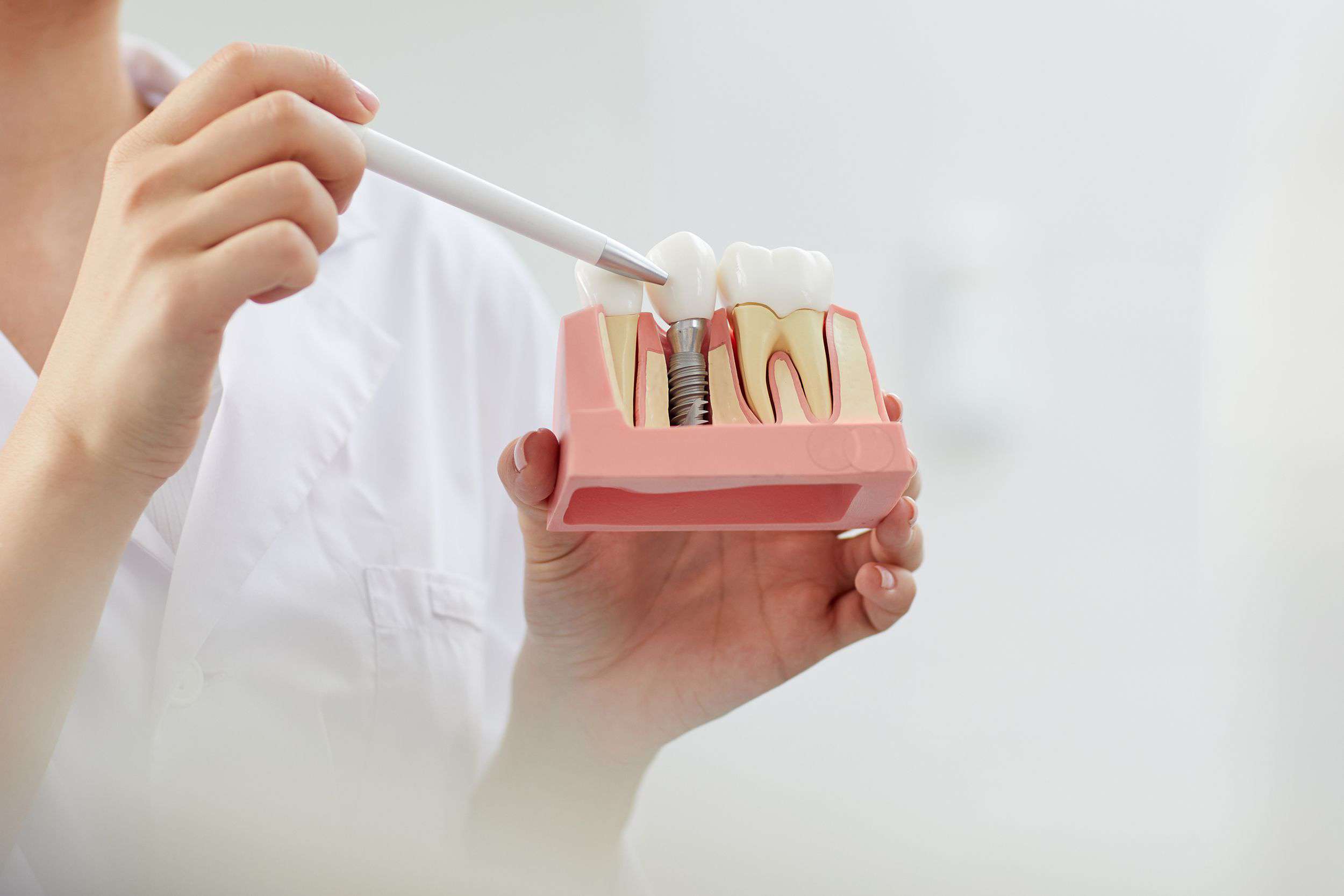 Dental Implants